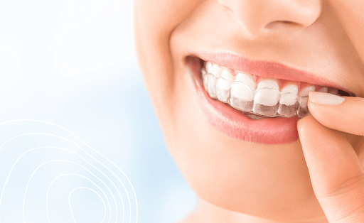 Nakładki InVisalign. Jak o nie dbać?