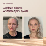 Przed i po stosowaniu DermaLight. Obecna para zdjęć efektów z landingu.