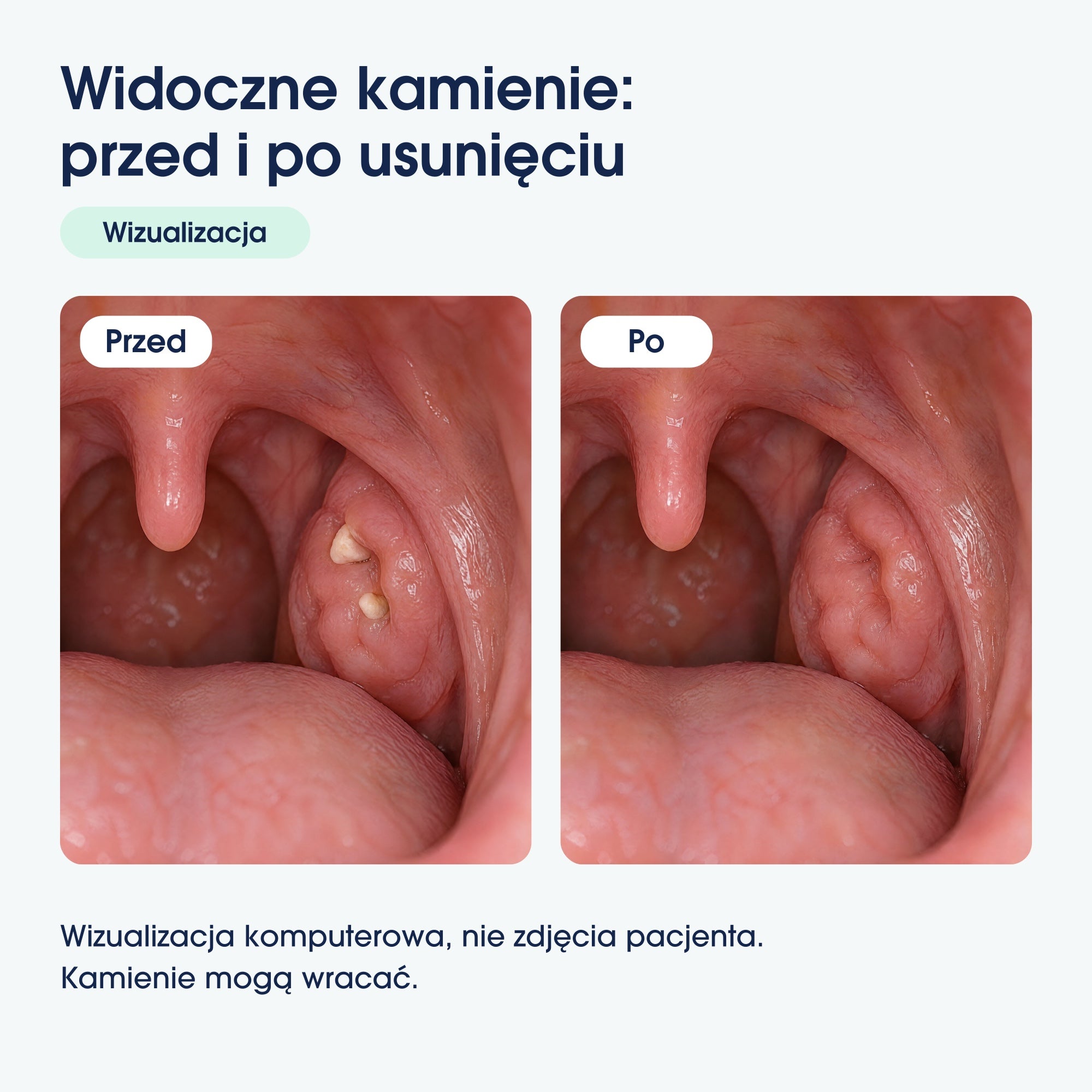 Wizualizacja komputerowa przed i po usunięciu widocznych kamieni migdałkowych. Nie zdjęcia pacjenta.